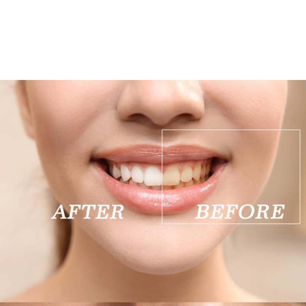 Kit gel sbiancante per denti c - Teeth Whitening (Bleaching) recensione e prezzo